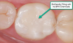 Picture of a dental mercury free/fluoride free dental filling treatment by Premier Holistic Dental in London.