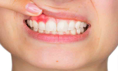 Close-up picture of a woman showing her teeth and gums and displaying a periodontal disease condition that needs to be treated.