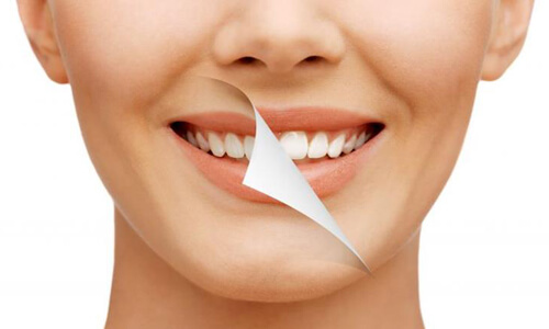 Close-up picture of a smiling woman showing the difference between normal teeth and new teeth created by a Prosthodontist at Premier Holistic Dental in San Jose, Costa Rica.