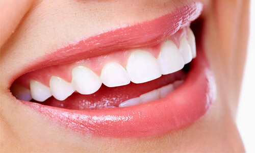 Close-up picture of a smiling woman’s perfect teeth showing her happiness with the periodontal ligament removal procedure she had in Costa Rica.