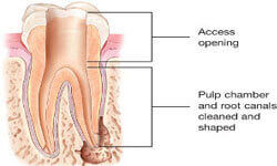 Illustration of a Holistic Root Canal being performed in the upper jaw by Premier Holistic Dental in London.