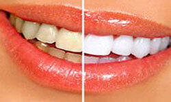 Picture of a smiling woman showing a Dental Whitening procedure by Premier Holistic Dental in London.